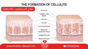 دليلك لعلاج السيلوليت بالاجهزة وجلسات التخسيس بالليزر
