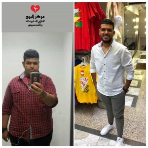 حقن الميزوثيرابي للتخسيس قبل وبعد