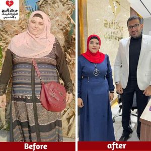 تجارب حقن الميزوثيرابي للتخسيس